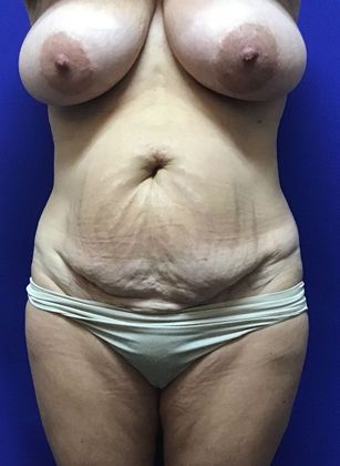 Body Tummy Tuck / Abdominoplasty Case 20 (22789) - Before