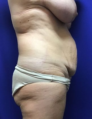 Body Tummy Tuck / Abdominoplasty: Case 20 (22789) - Before