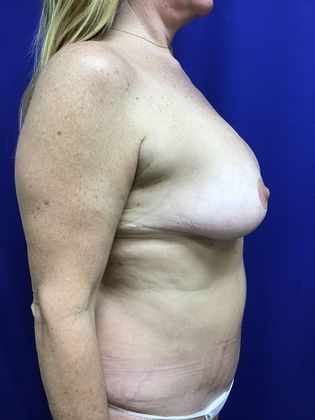 Body Tummy Tuck / Abdominoplasty: Case 20 (22789) - After