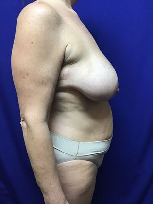 Body Tummy Tuck / Abdominoplasty: Case 20 (22789) - Before