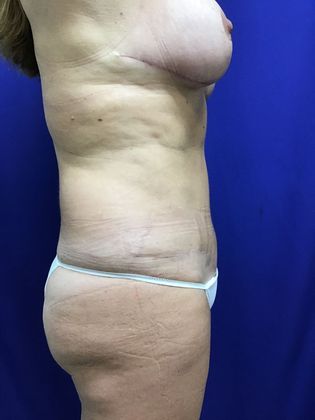 Breast Reduction: Case 29 (22789) - After