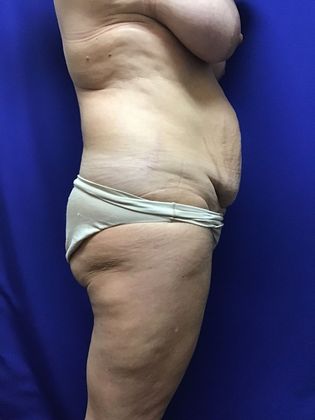 Breast Reduction: Case 29 (22789) - Before