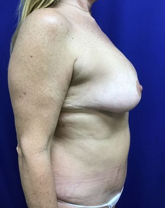 Breast Reduction: Case 29 (22789) - After