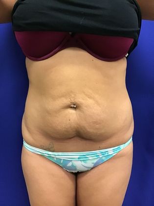 Body Tummy Tuck / Abdominoplasty Case 21 (18924) - Before