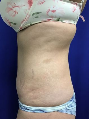 Body Tummy Tuck / Abdominoplasty: Case 21 (18924) - After