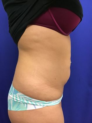 Body Tummy Tuck / Abdominoplasty: Case 21 (18924) - Before
