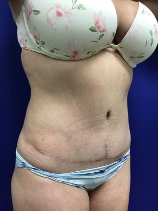 Body Tummy Tuck / Abdominoplasty: Case 21 (18924) - After