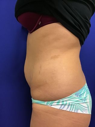 Body Tummy Tuck / Abdominoplasty: Case 21 (18924) - Before