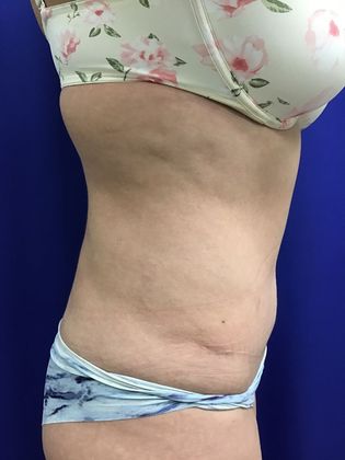 Body Tummy Tuck / Abdominoplasty: Case 21 (18924) - Before