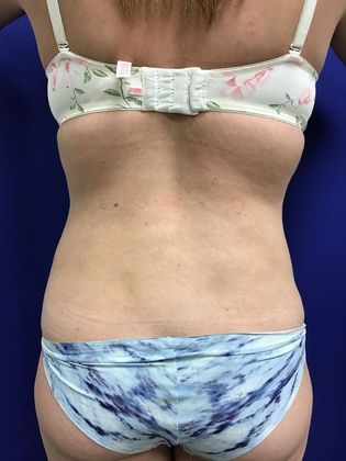 Body Tummy Tuck / Abdominoplasty: Case 21 (18924) - Before