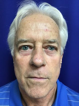 Male Face Case 3 - Before