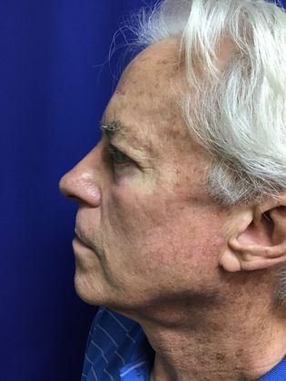 Male Face: Case 3 - Before