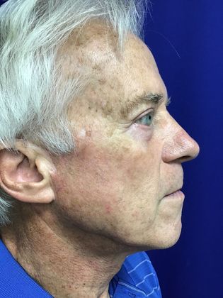 Male Face: Case 3 - After