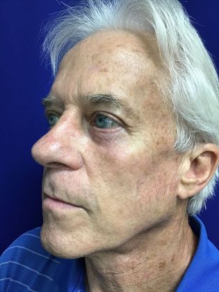 Male Face: Case 3 - After