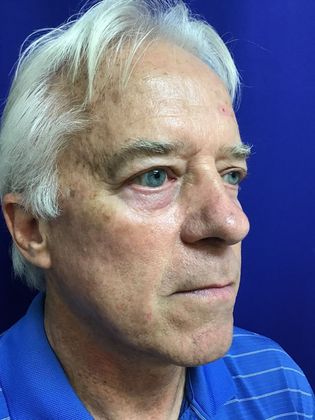 Male Face: Case 3 - Before