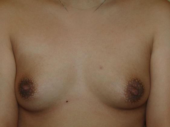 Breast Augmentation Case 593 - Before