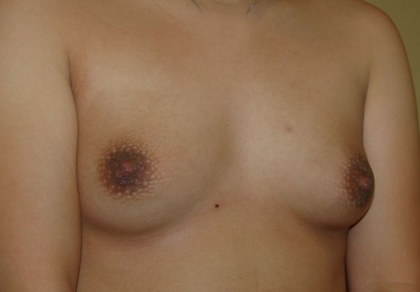 Breast Augmentation: Case 593 - Before