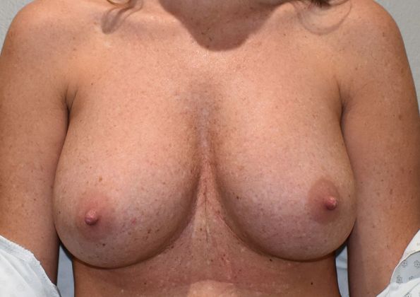 Breast Revision: Case 142 - Before