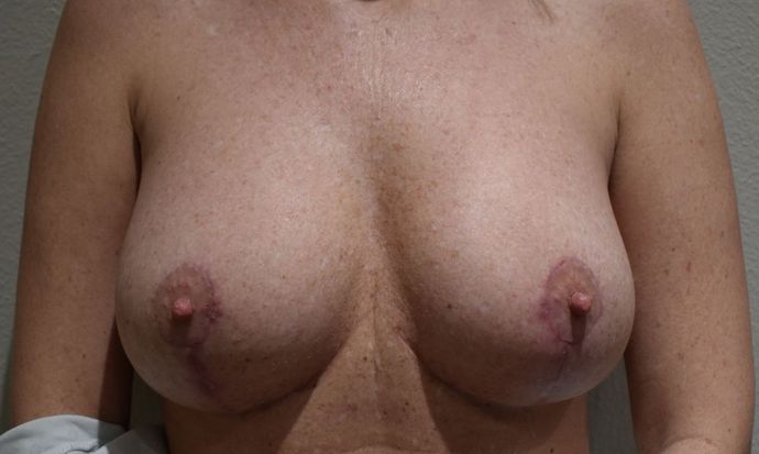 Breast Revision: Case 142 - After