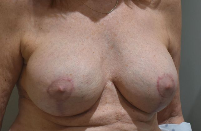 Breast Revision: Case 132 - After
