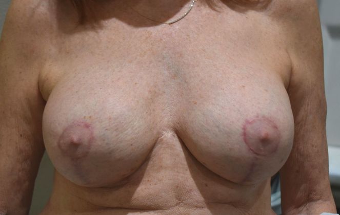 Breast Augmentation w/ Lift: Case 312 - After