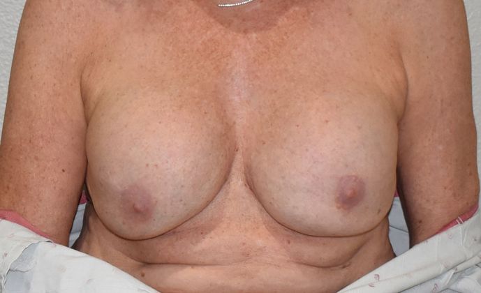 Breast Augmentation w/ Lift: Case 312 - Before