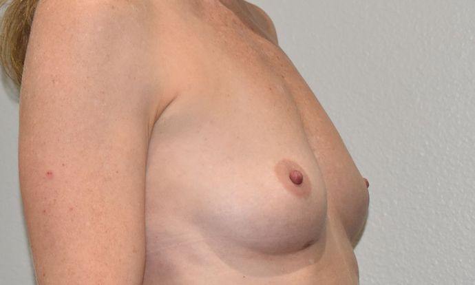 Breast Augmentation: Case 594 - Before