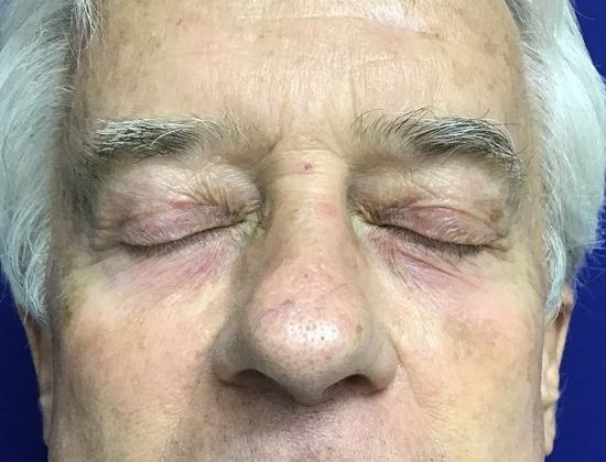 Male Face: Case 4 (20915) - After