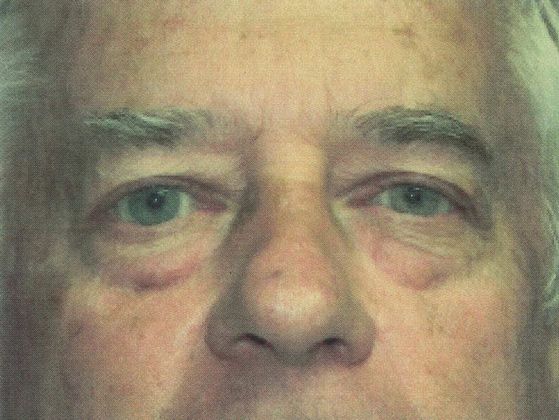 Male Face: Case 4 (20915) - Before