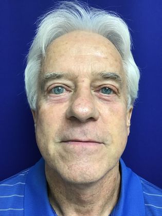 Male Face Case 4 (20915) - After