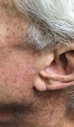 Male Face: Case 4 (20915) - After, scar close-up