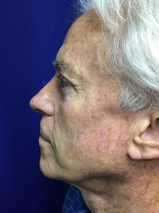 Male Face: Case 4 (20915) - After