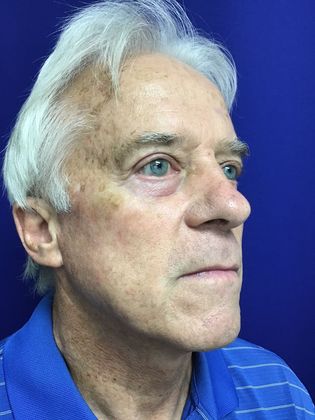 Male Face: Case 4 (20915) - After