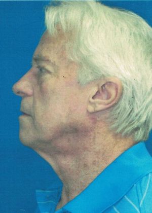 Male Face: Case 4 (20915) - Before