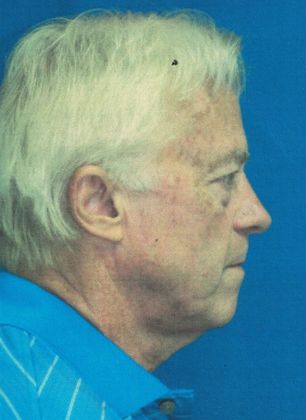 Male Face: Case 4 (20915) - Before