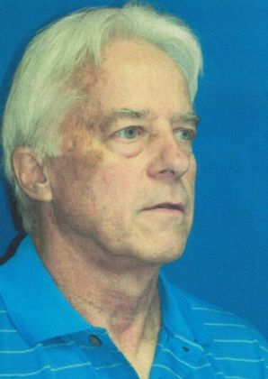 Male Face: Case 4 (20915) - Before