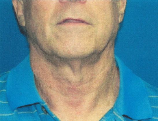 Male Face: Case 4 (20915) - Before, neck bands & fullness