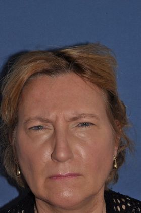 Endoscopic Browlift: Lovely woman with brow and facelift - Before