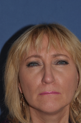 Endoscopic Browlift: Lovely woman with brow and facelift - After