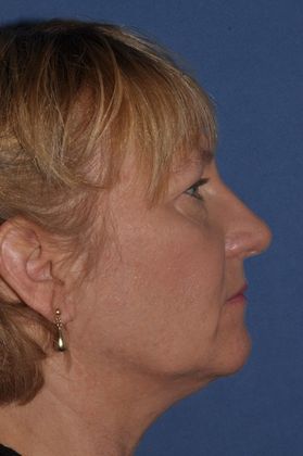 Endoscopic Browlift: Lovely woman with brow and facelift - Before