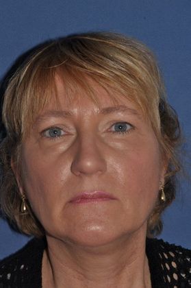 Endoscopic Browlift: Lovely woman with brow and facelift - Before