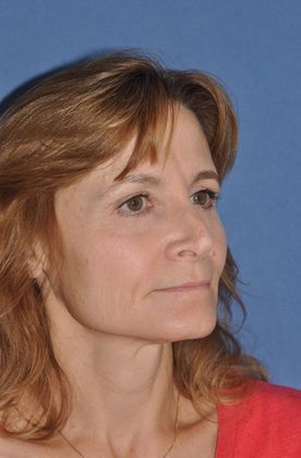 Facelift: Facelift and rhinoplasty can be combined - Before