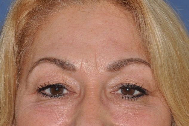 Eyelid Surgery Upper and lower lids - Before