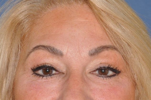 Eyelid Surgery Upper and lower lids - After