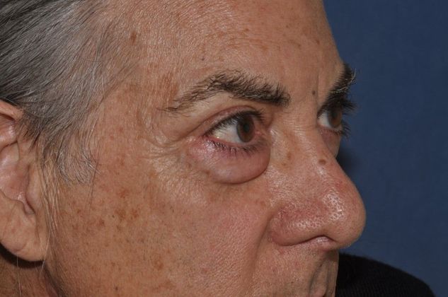 Eyelid Surgery Lower lid bleph with fat transposition and removal in a severe case  - Before