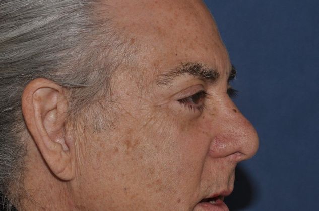 Eyelid Surgery Lower lid bleph with fat transposition and removal in a severe case  - After