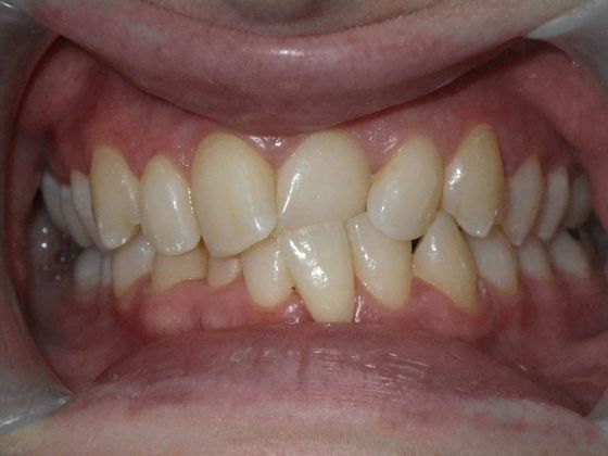 Orthodontics: Case 1 - Before