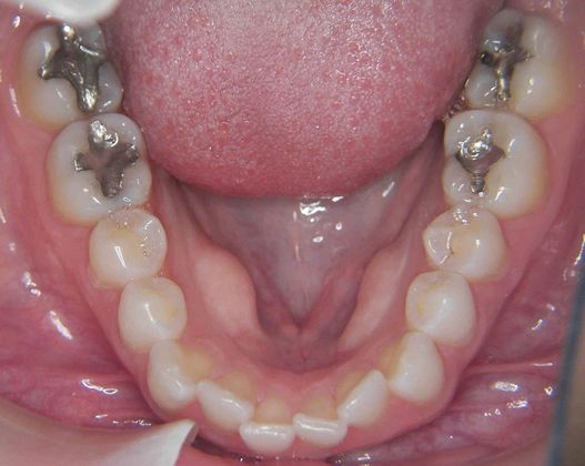 Invisalign: Case 1 - Before