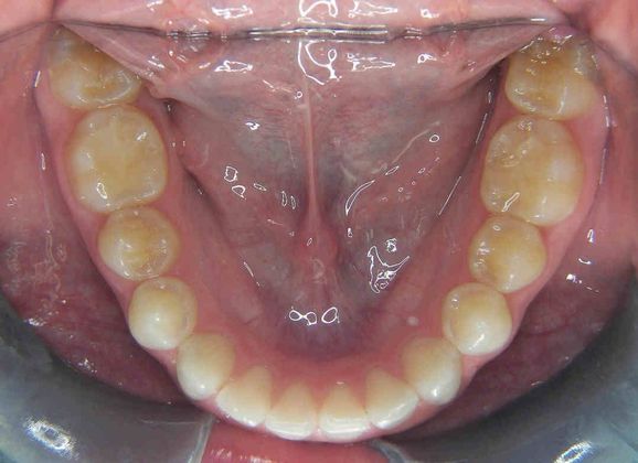 Invisalign: Case 2 - Before