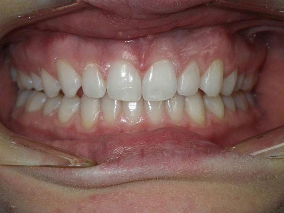 Invisalign: Case 2 - After